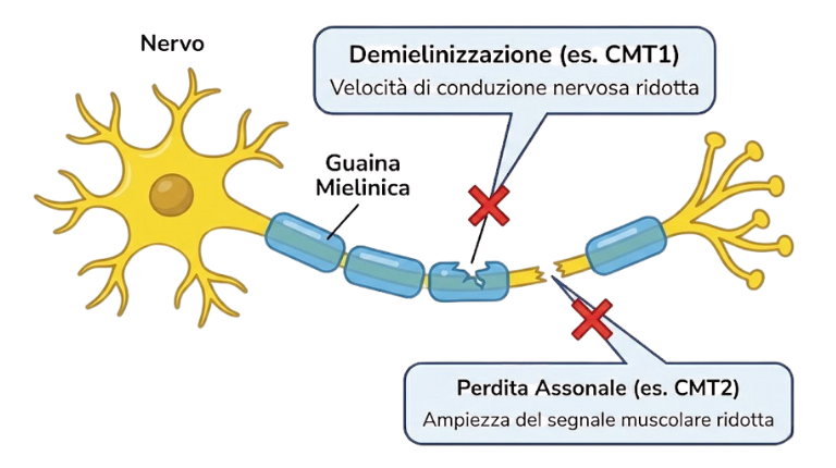 CMT demielinizzante e CMT assonale le differenze