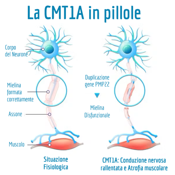Charcot-Marie-Tooth di tipo 1A CMT1A