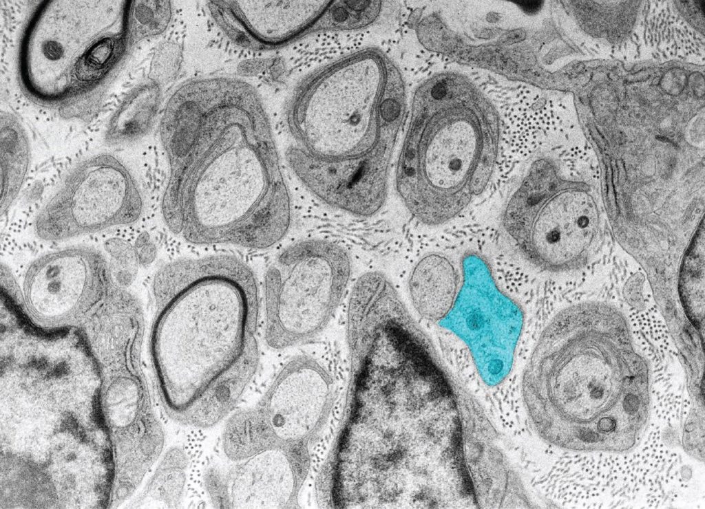 La PMP22 inibisce il metabolismo del colesterolo in cellule staminali di CMT1A