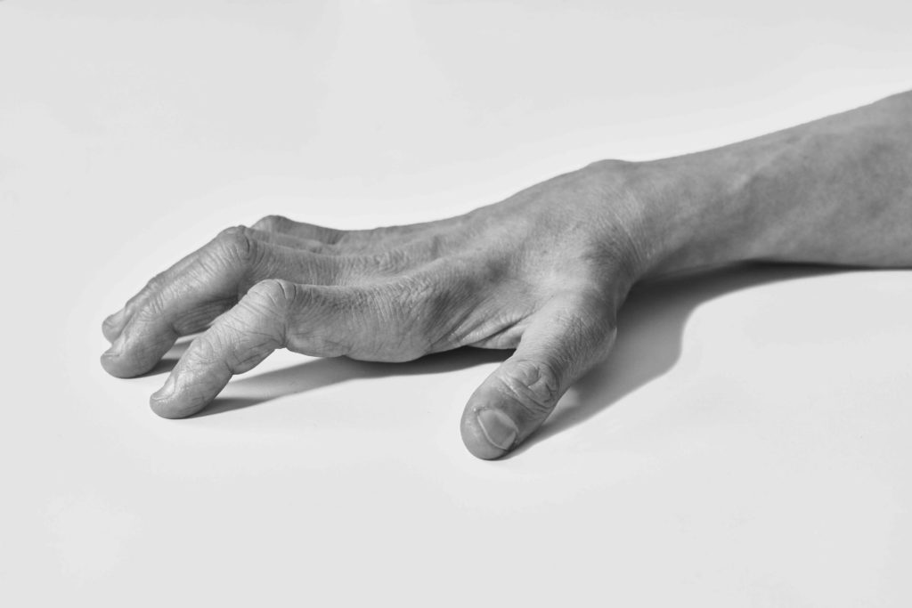 Mani con CMT nella mostra di Aliteia The Ballad of Human Mutations