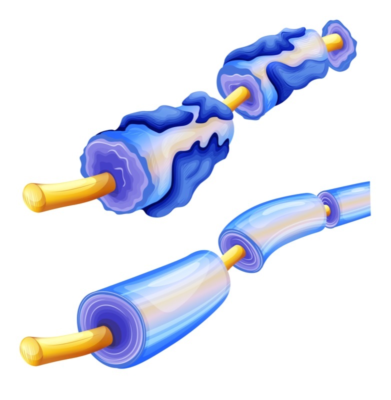 Mielina nella CMT o malattia di Charcot-Marie-Tooth - Cellule di Schwann