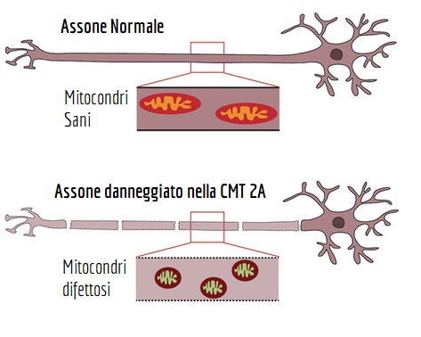 La Charcot-Marie-Tooth 2A e la Mitofusina 2: Uno studio internazionale