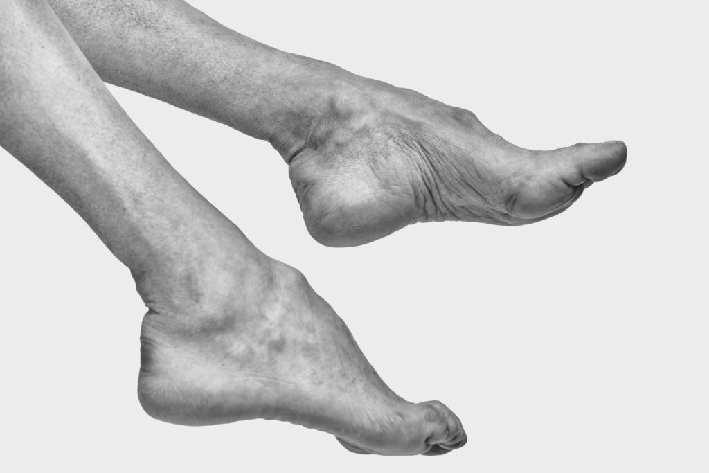 Piedi con CMT nella mostra di Aliteia The Ballad of Human Mutations