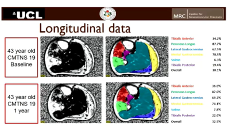 Risonanza magnetica e Charcot-Marie-Tooth o CMT