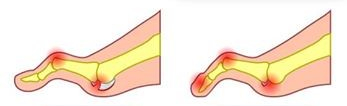 ortesi e tutori per la Charcot-Marie-Tooth dita CMT